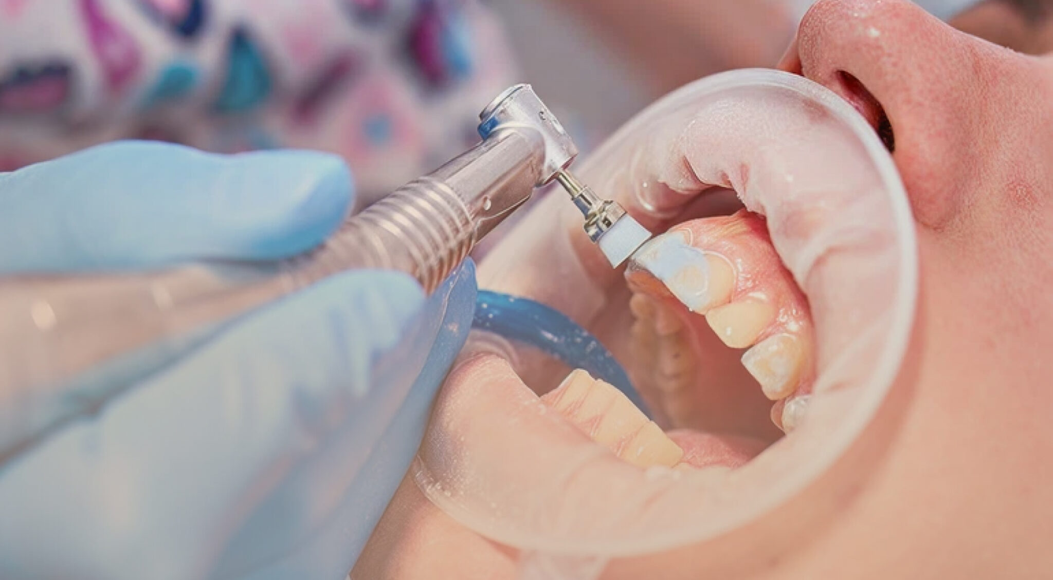 atliekama burnos higiena odontologijos klinikoje