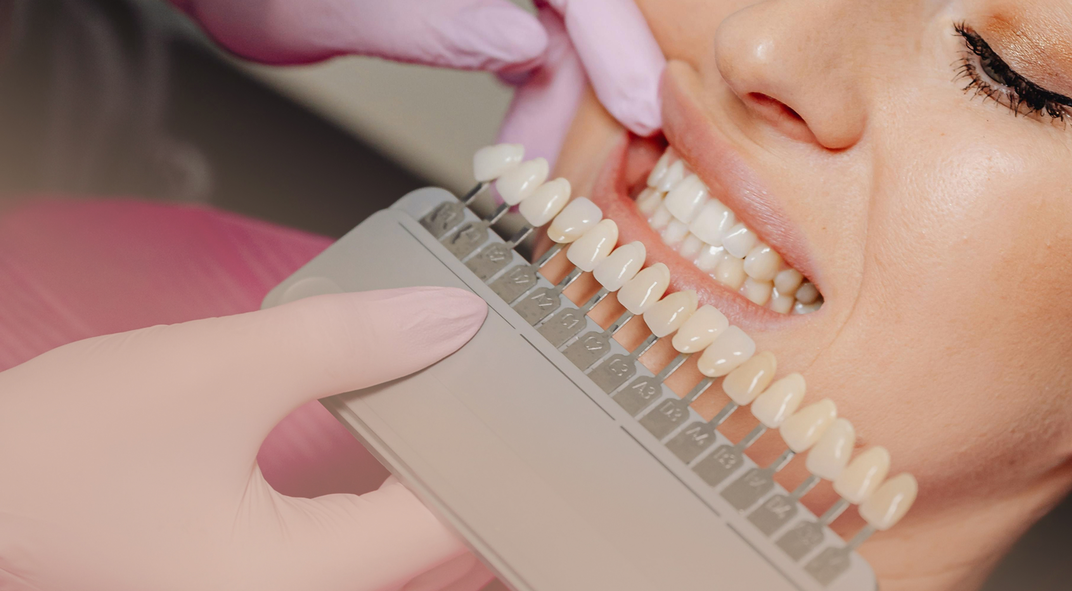 atitaikomas naturalus dantų atspalvis odontologijos klinikoje prieš plombavimą