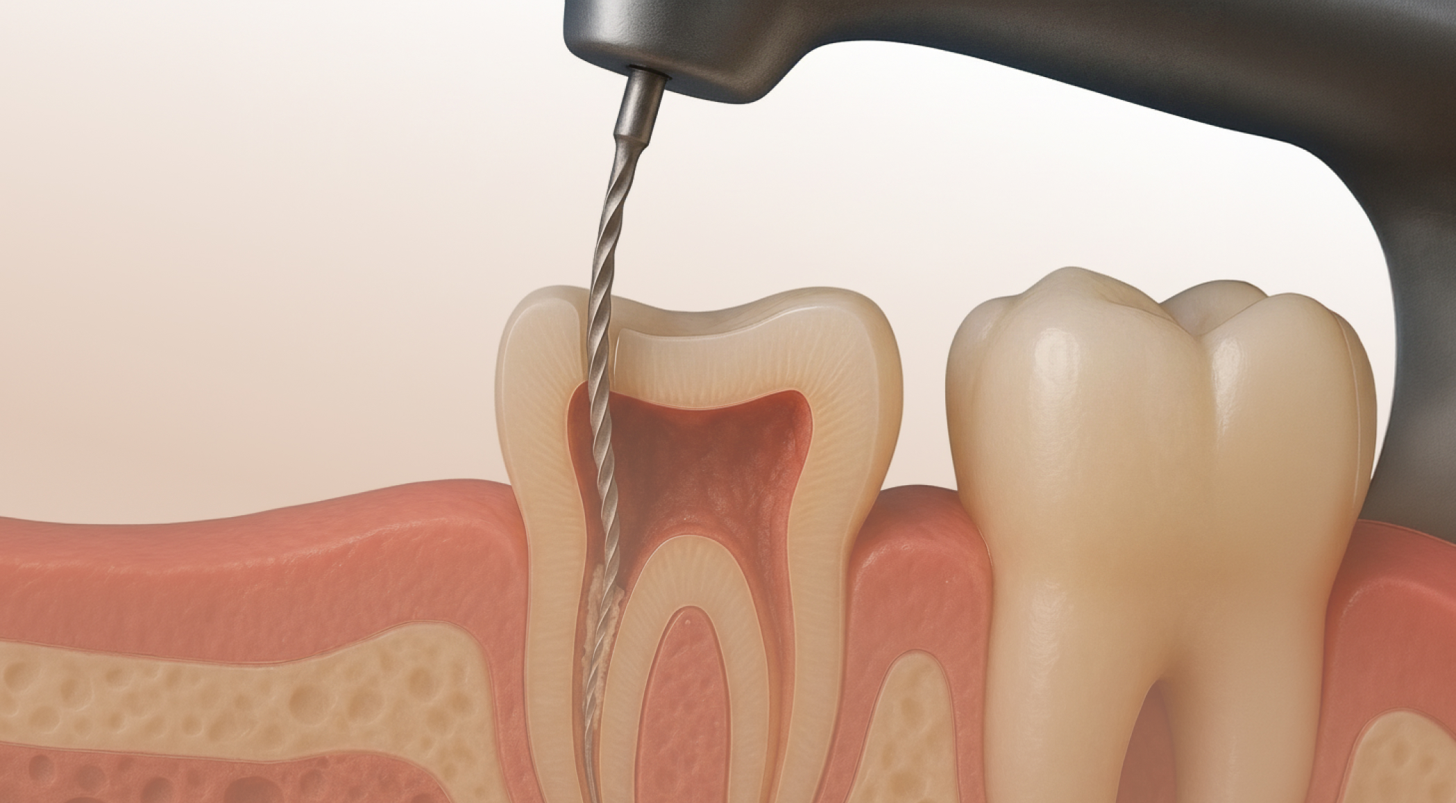 Dantų kanalų gydymas širvintuose